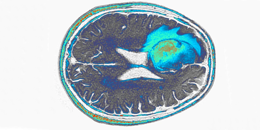Glioblastoma (verde-azul, colorido artificialmente) crescendo no lobo frontal do cérebro humano Foto: Pr Michel Brauner, ISM/Science Photo Library